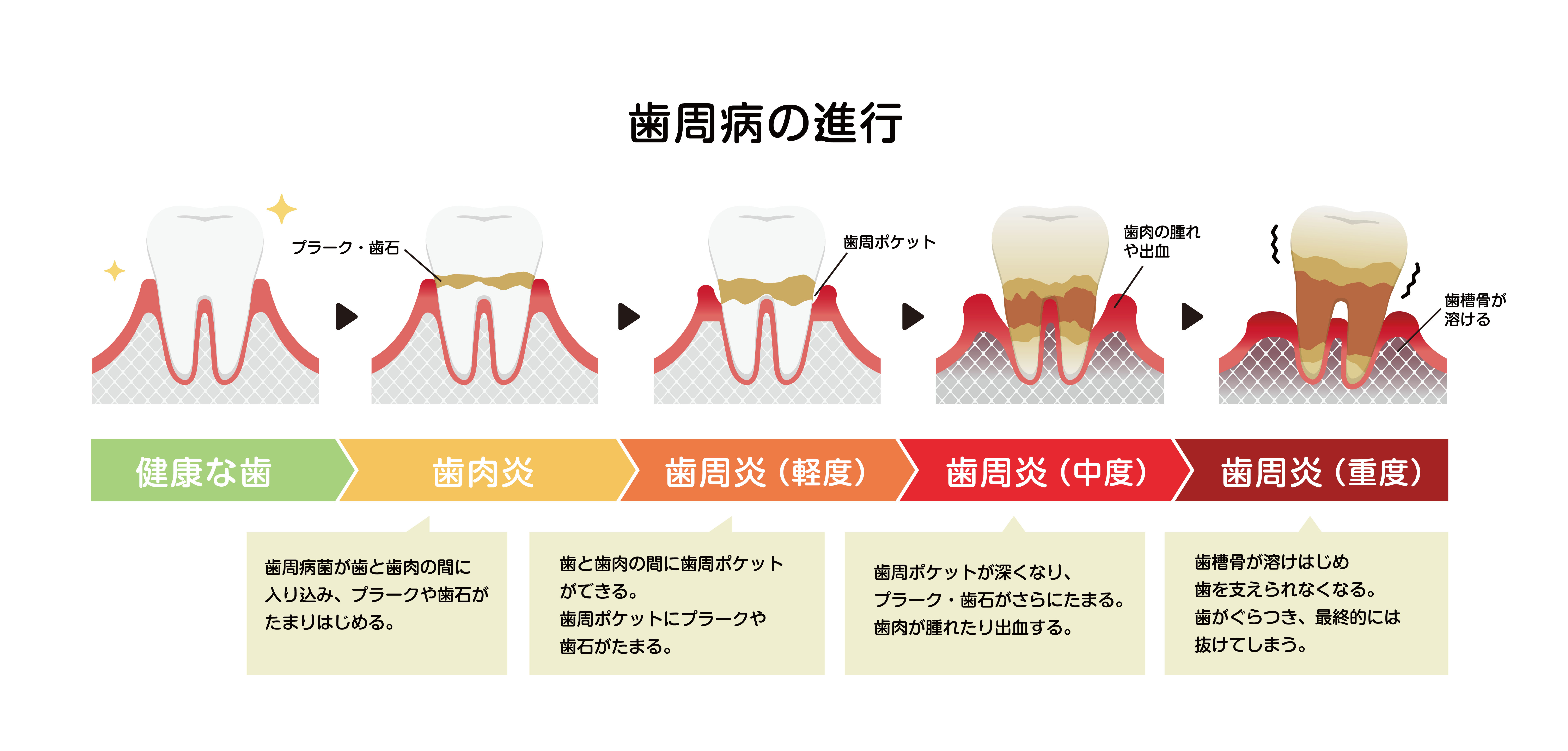 歯周病.jpg